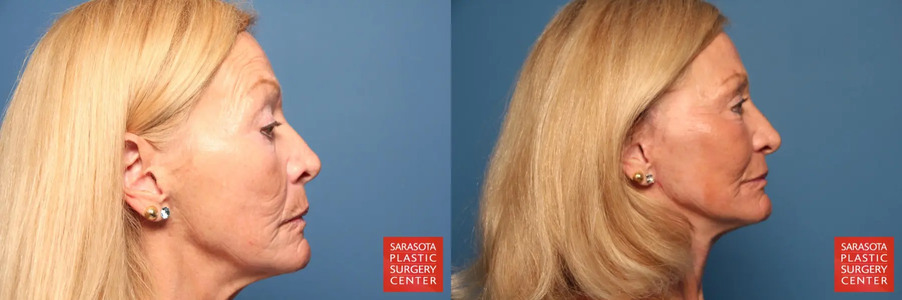 Cheek Lift: Patient 5 - Before and After 5