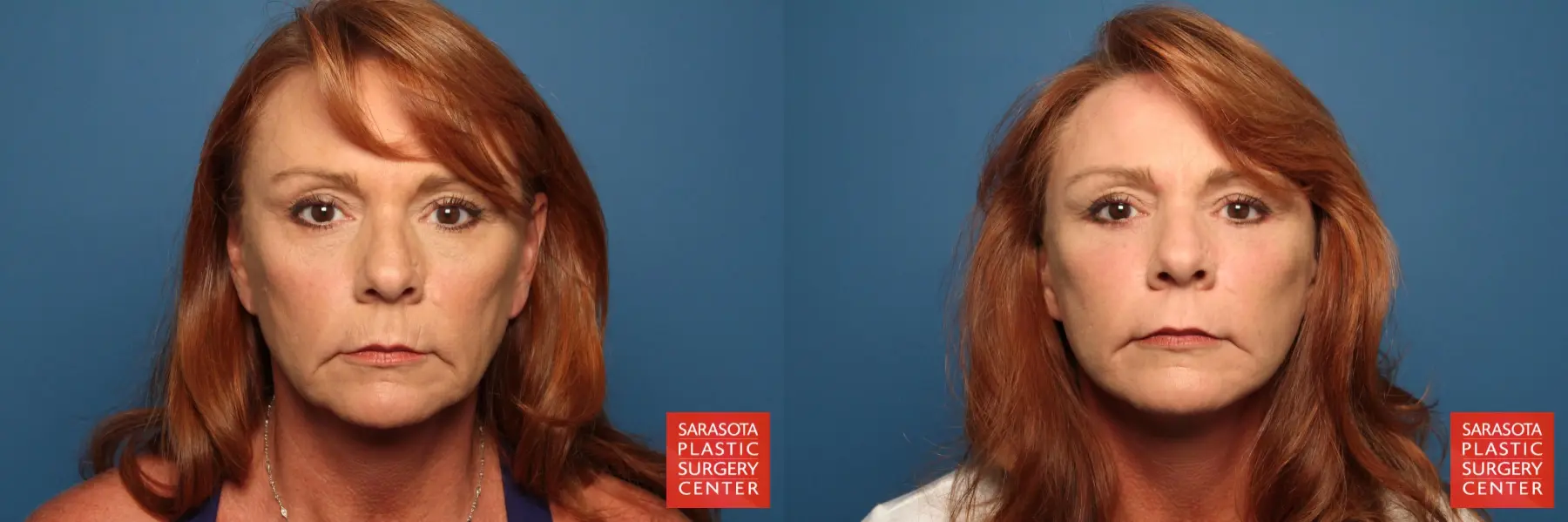 Cheek Lift: Patient 9 - Before and After 1