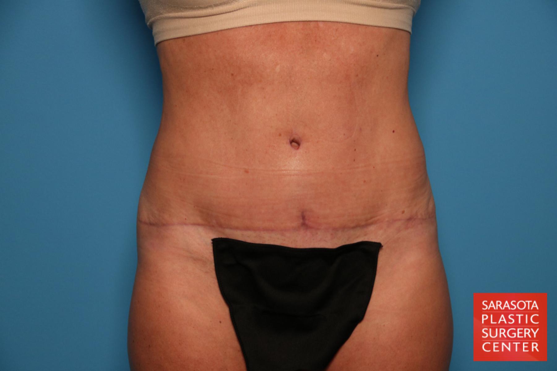 Tummy Tuck: Patient 10 - After 1