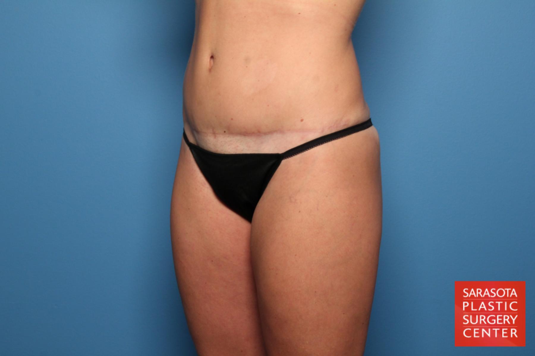 Liposuction: Patient 14 - After 2