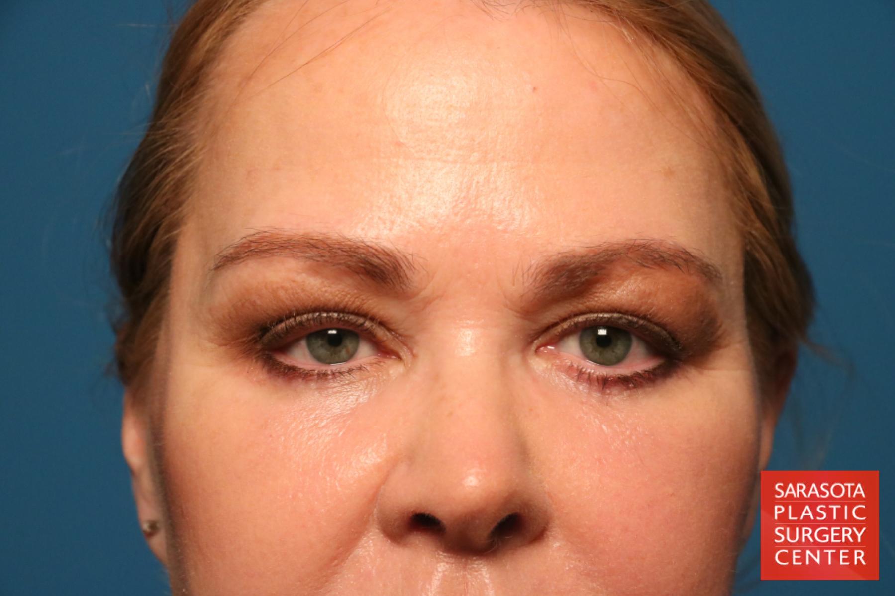 Eyelid Lift: Patient 44 - After 1