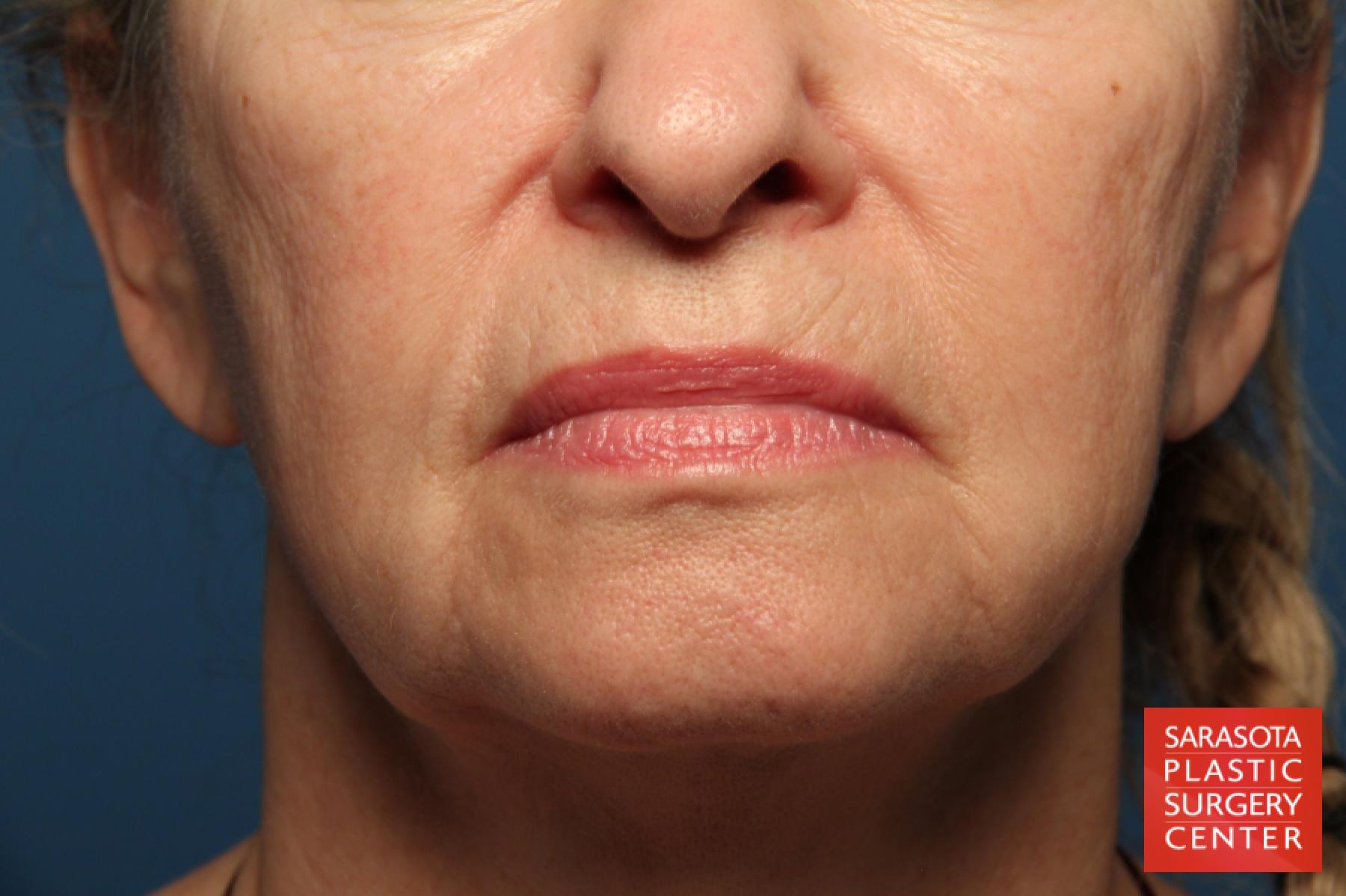 Laser Skin Resurfacing - Face: Patient 1 - Before 1