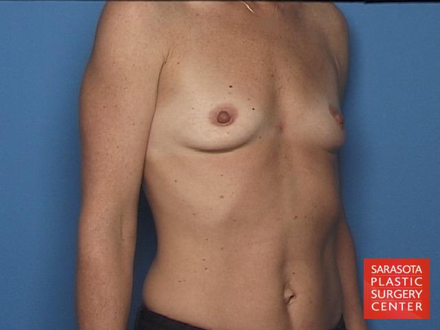 Breast Augmentation: Patient 35 - Before 2