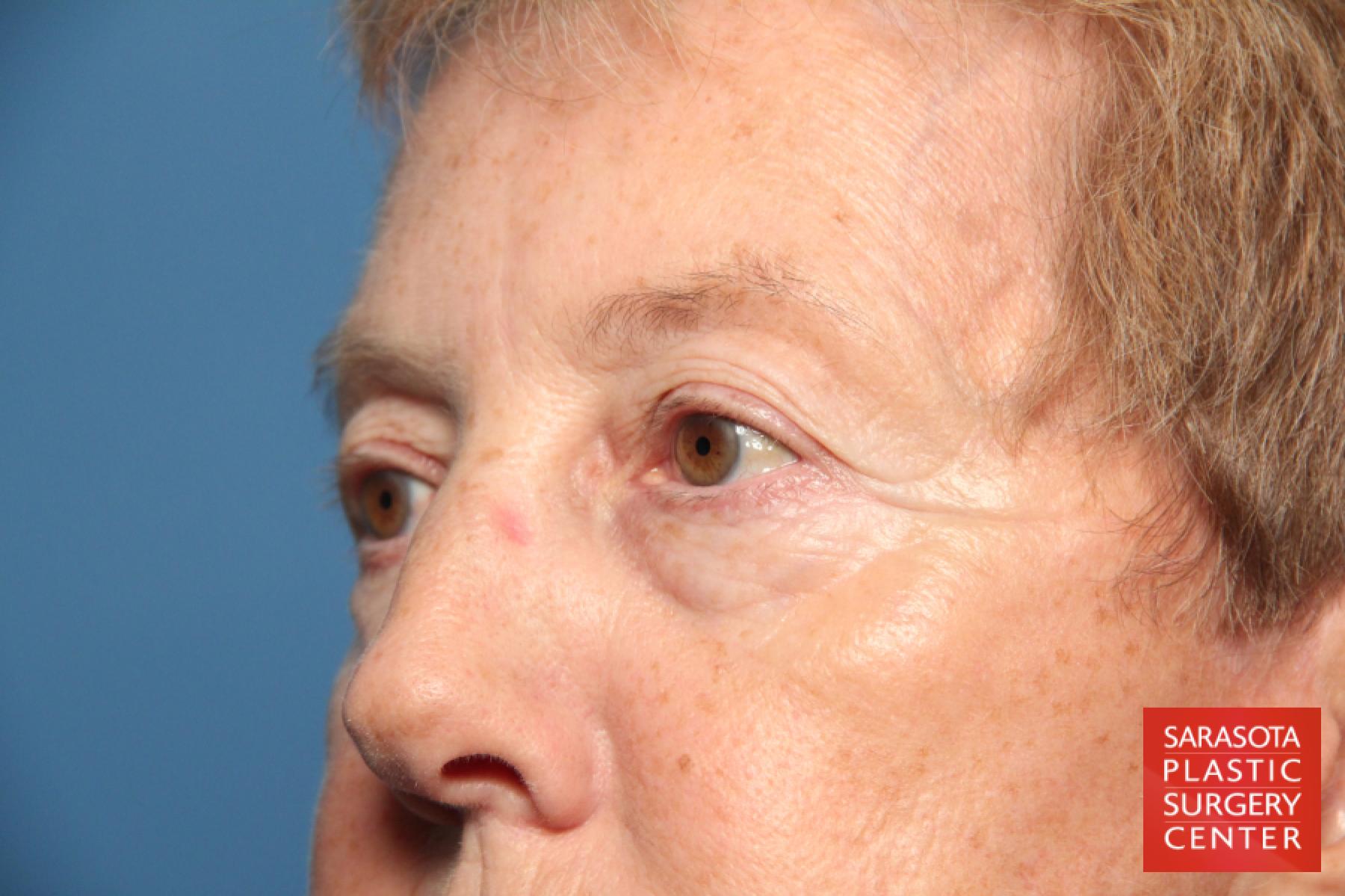 Eyelid Lift: Patient 22 - Before 4