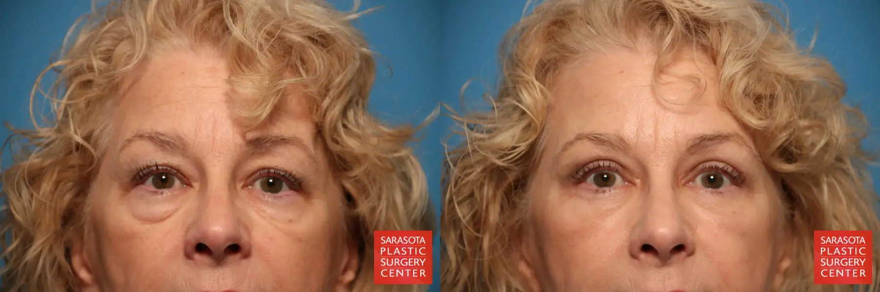 Eyelid Lift: Patient 21 - Before and After  