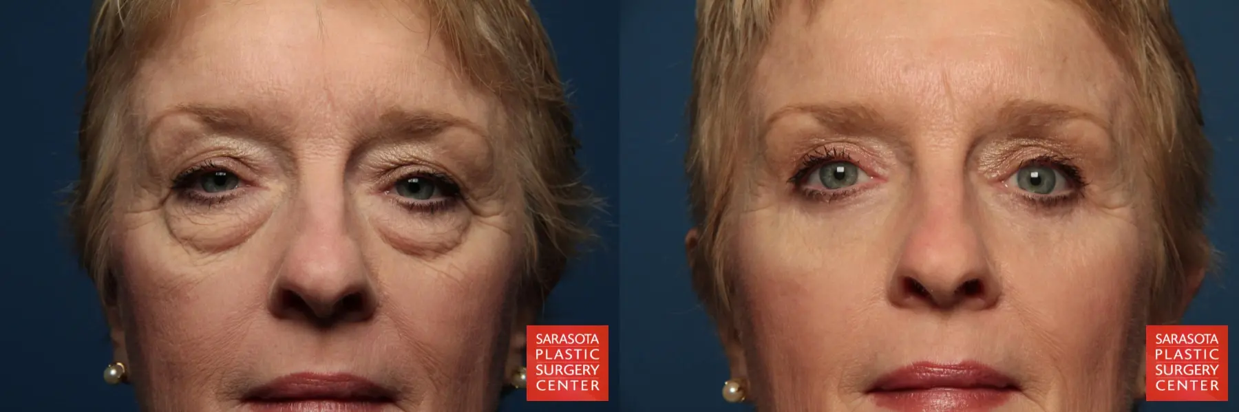 Eyelid Lift: Patient 1 - Before and After 1