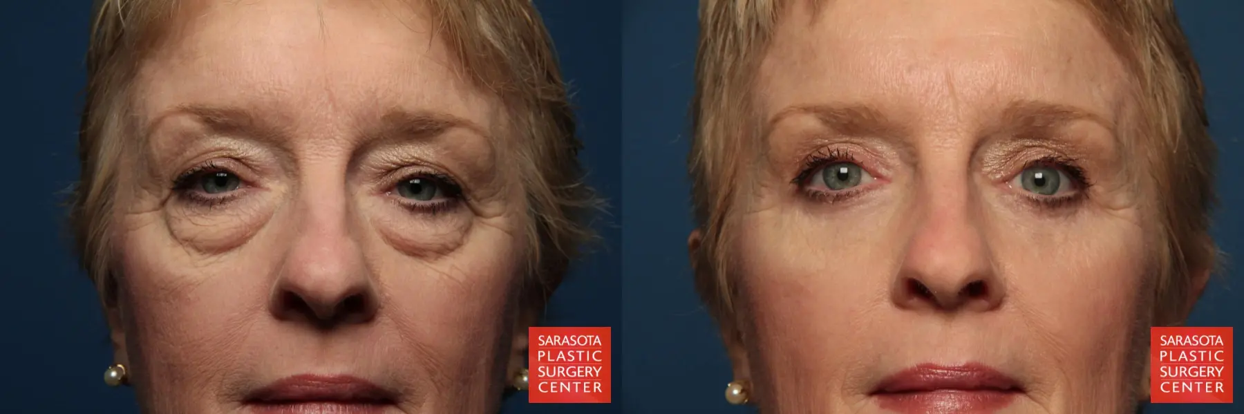 Eyelid Lift: Patient 1 - Before and After  