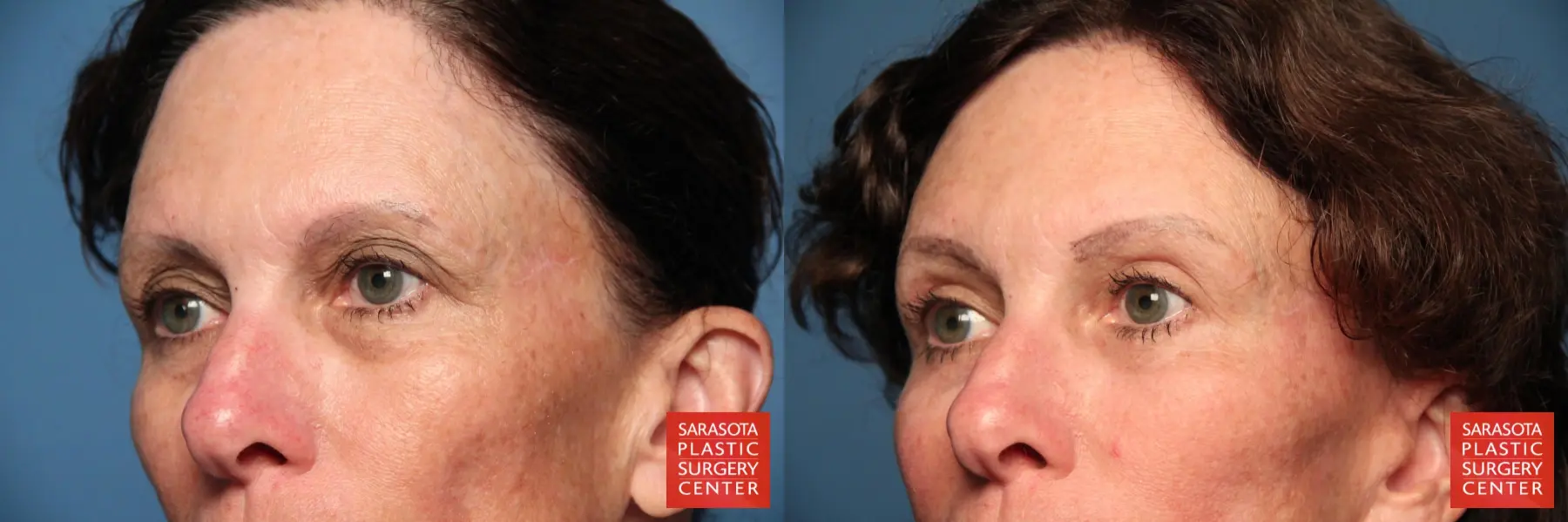 Eyelid Lift: Patient 8 - Before and After 3
