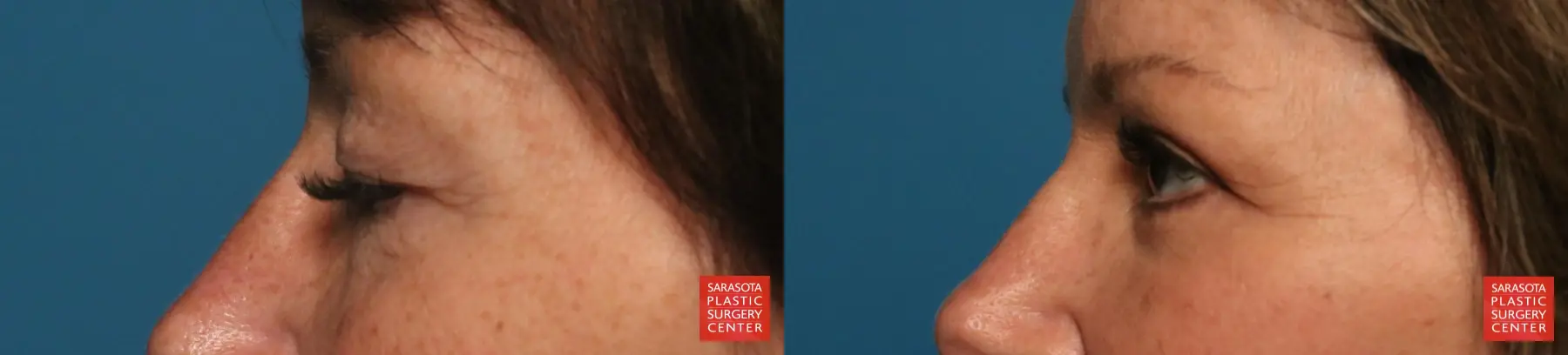 Eyelid Lift: Patient 67 - Before and After 4