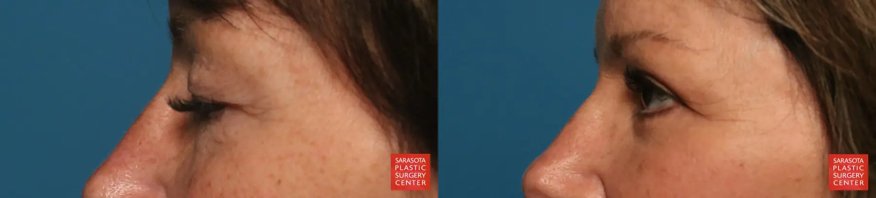 Eyelid Lift: Patient 69 - Before and After 4
