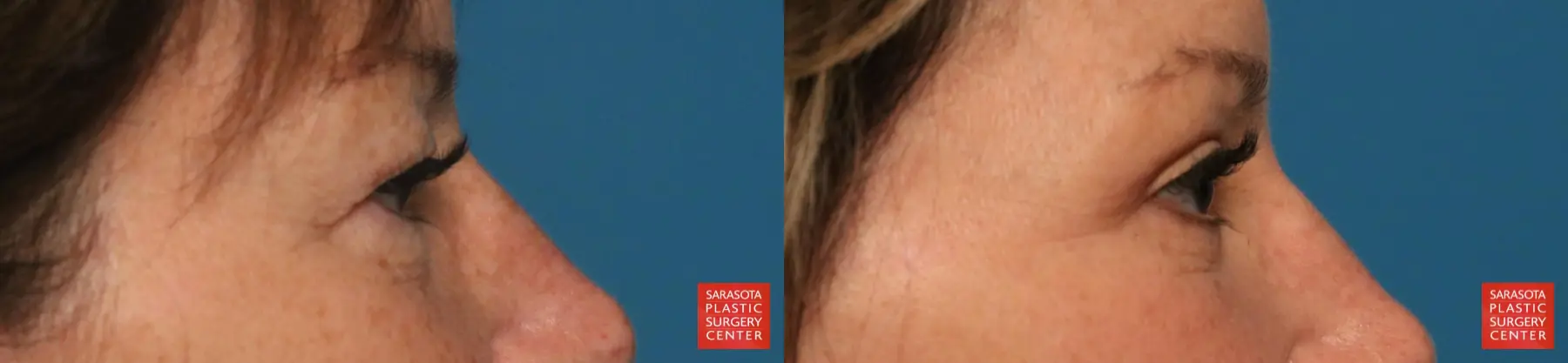Eyelid Lift: Patient 67 - Before and After 6