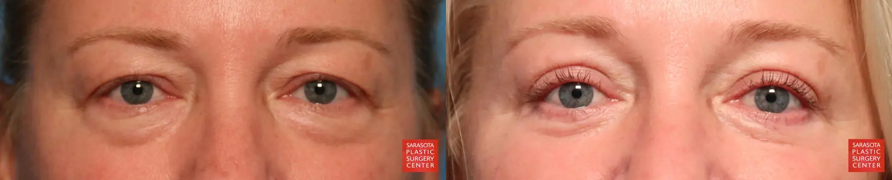 Eyelid Lift: Patient 66 - Before and After 1