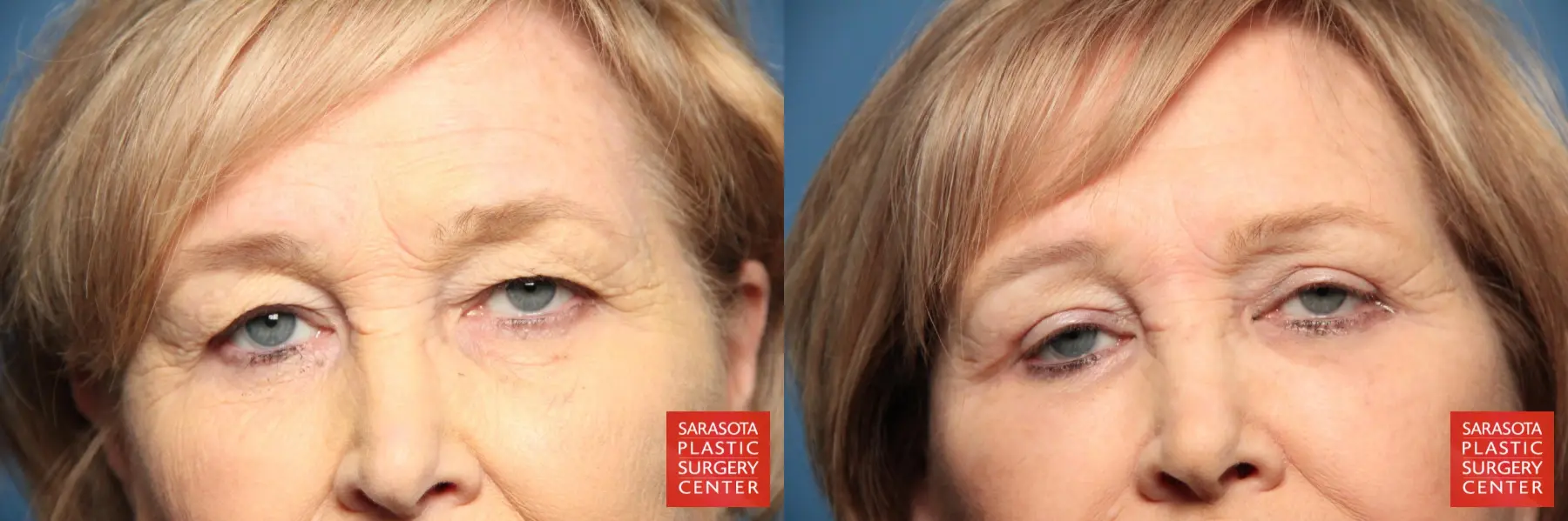 Eyelid Lift: Patient 21 - Before and After 4