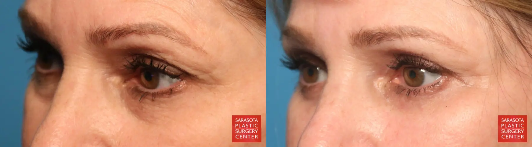 Eyelid Lift: Patient 53 - Before and After 3