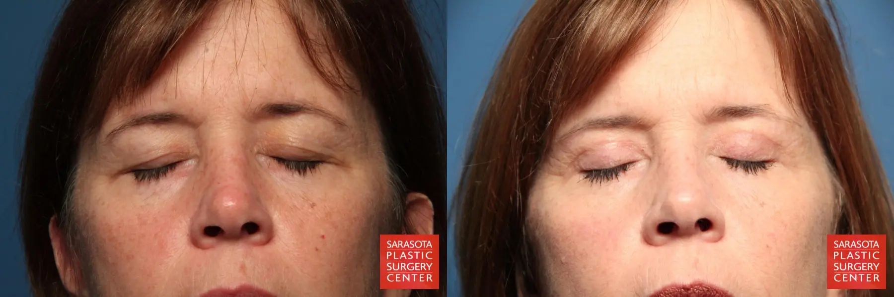 Eyelid Lift: Patient 37 - Before and After 5