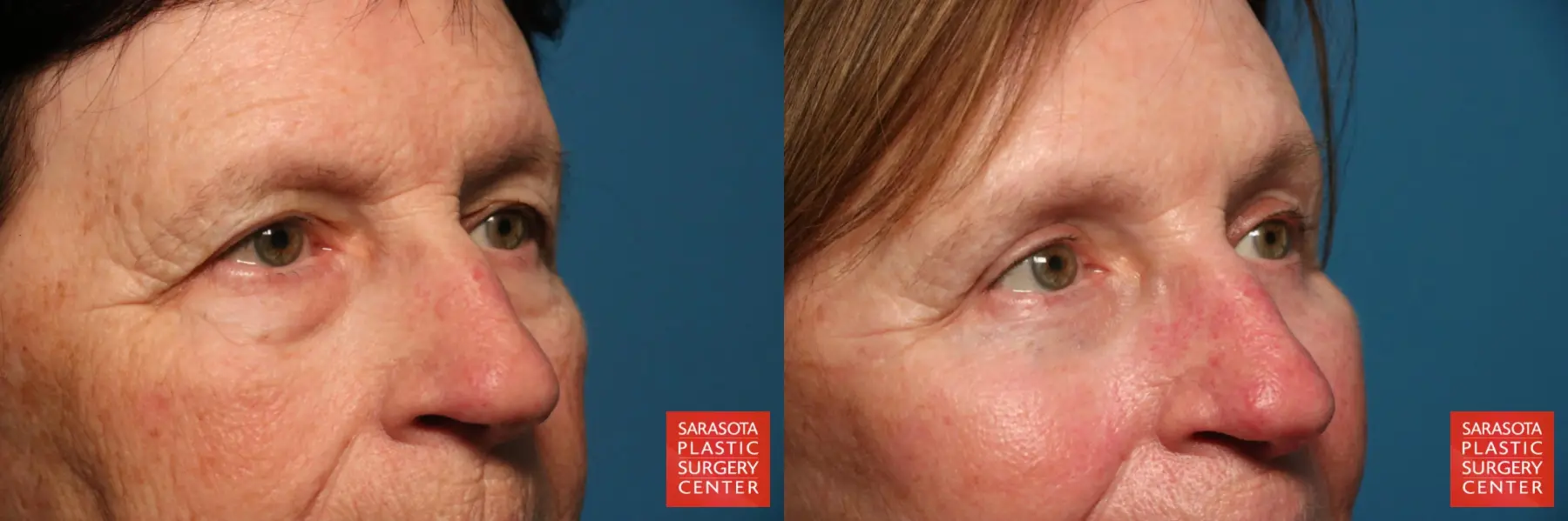 Eyelid Lift: Patient 51 - Before and After 4