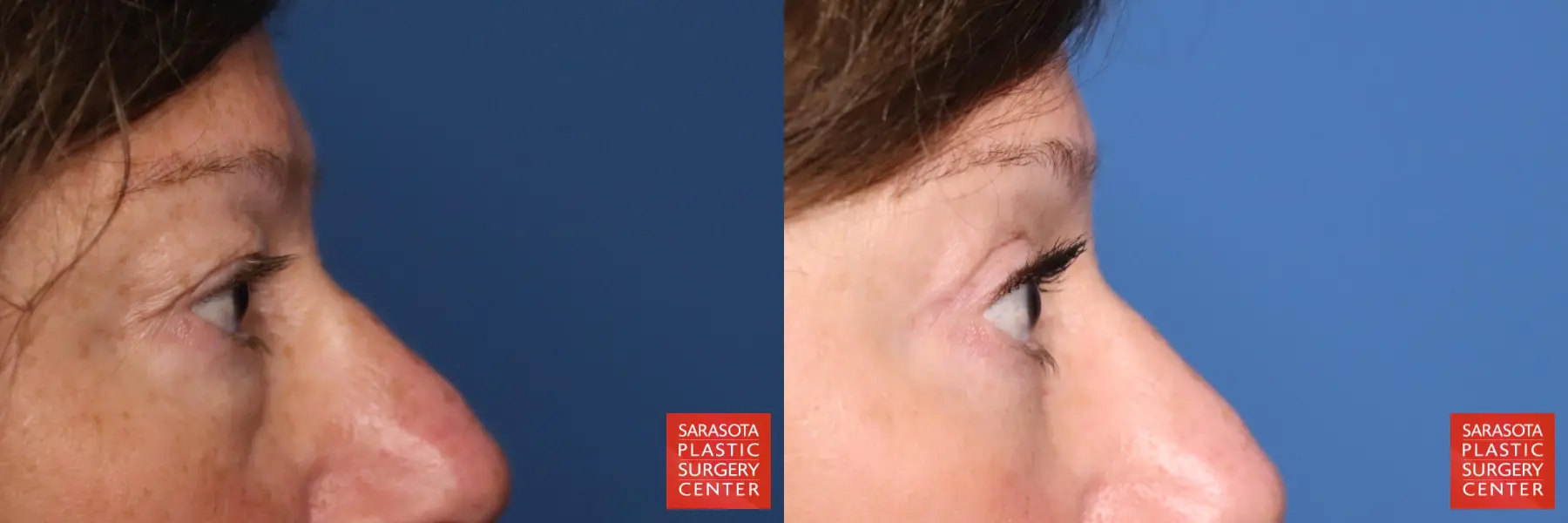 Eyelid Lift: Patient 58 - Before and After 7