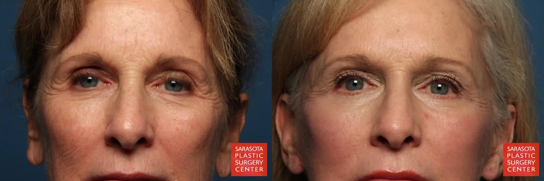 Eyelid Lift: Patient 4 - Before and After  