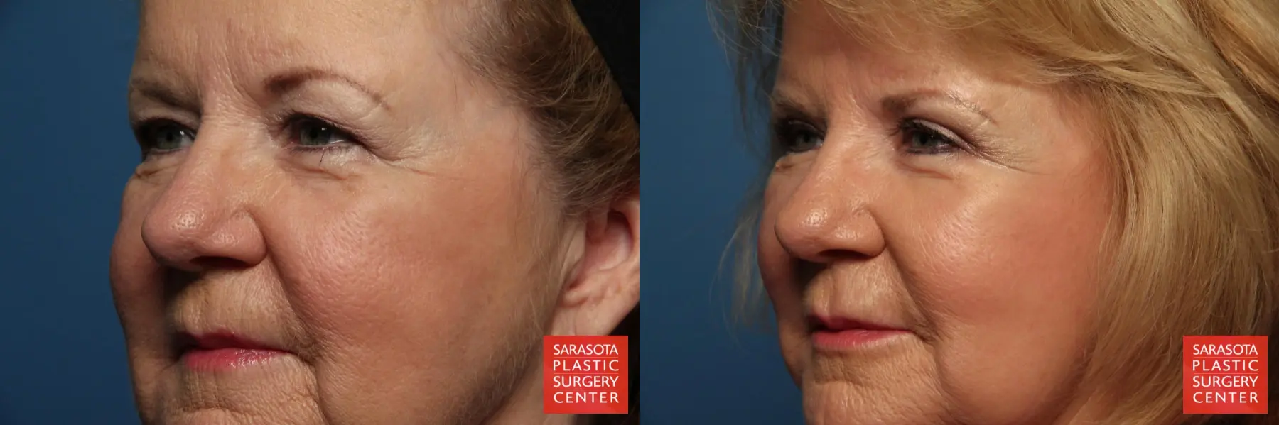 Eyelid Lift: Patient 33 - Before and After 2