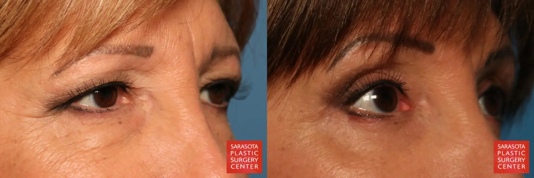 Eyelid Lift: Patient 9 - Before and After 6