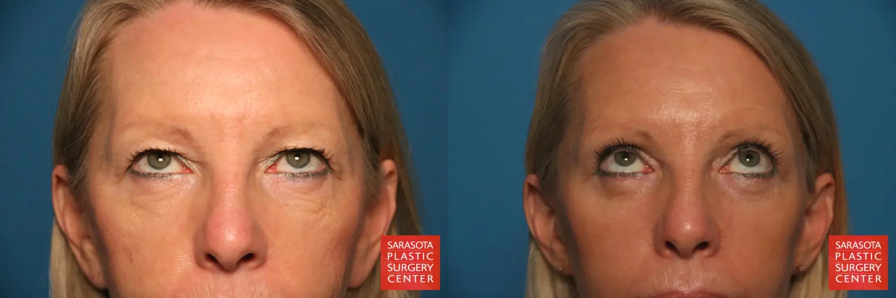 Eyelid Lift: Patient 54 - Before and After 3