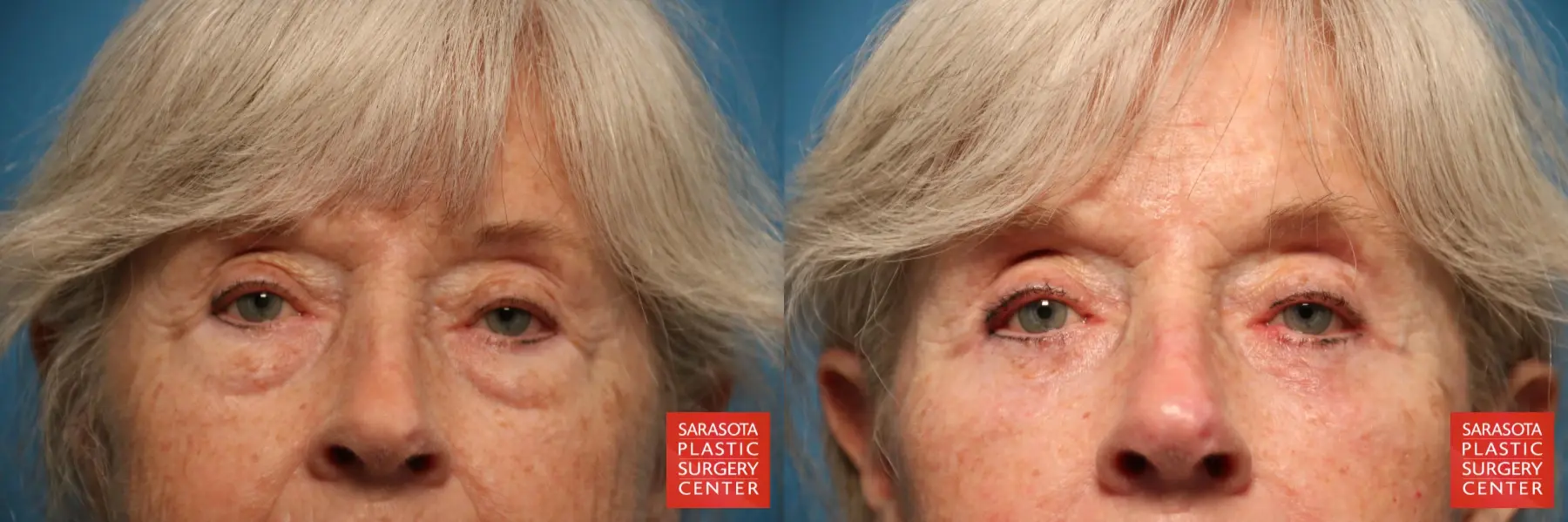 Eyelid Lift: Patient 16 - Before and After  