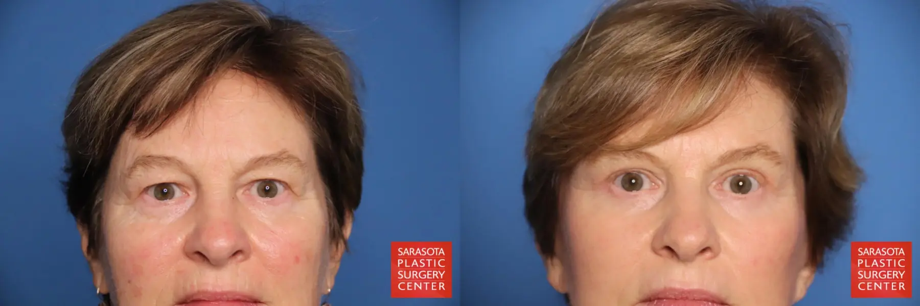 Eyelid Lift: Patient 67 - Before and After 1