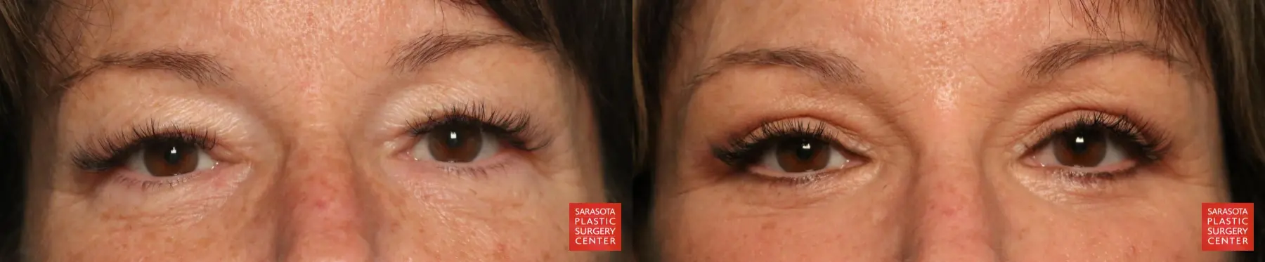 Eyelid Lift: Patient 67 - Before and After 1