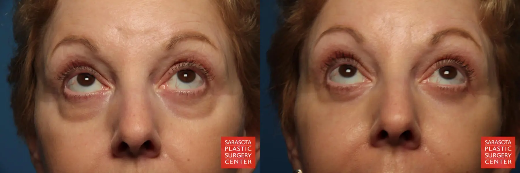 Eyelid Lift: Patient 41 - Before and After 2