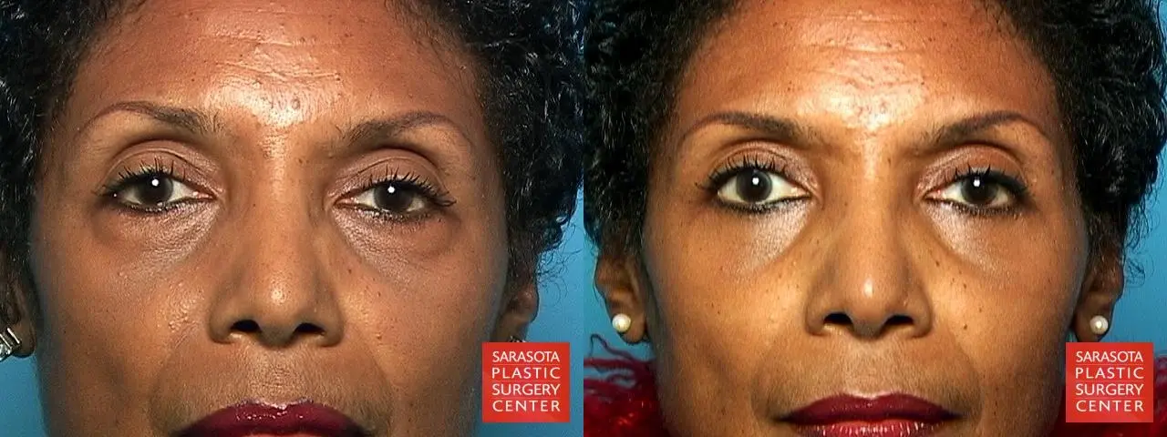 Eyelid Lift: Patient 10 - Before and After  