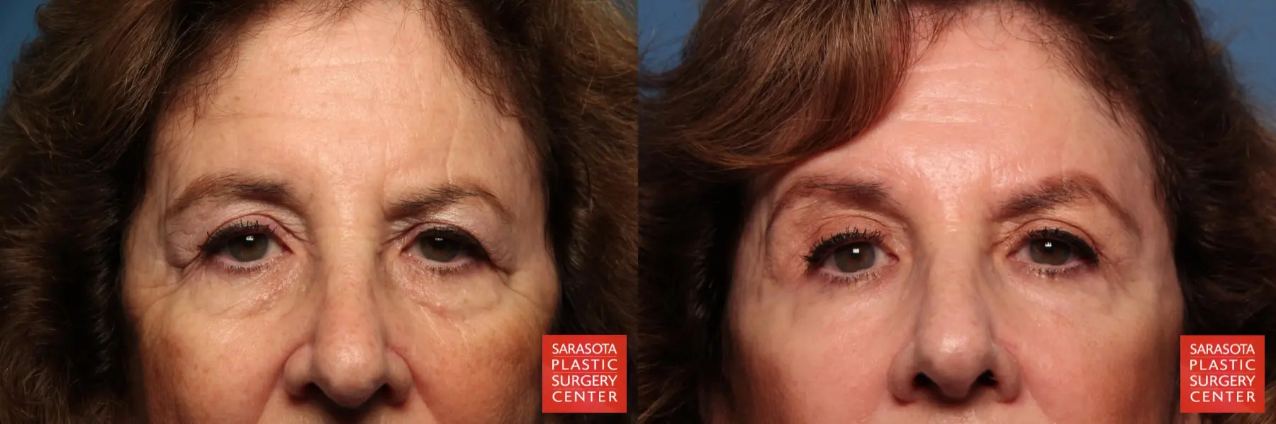 Eyelid Lift: Patient 42 - Before and After 1