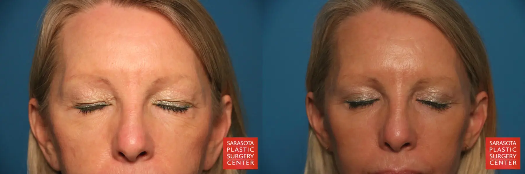Eyelid Lift: Patient 54 - Before and After 2