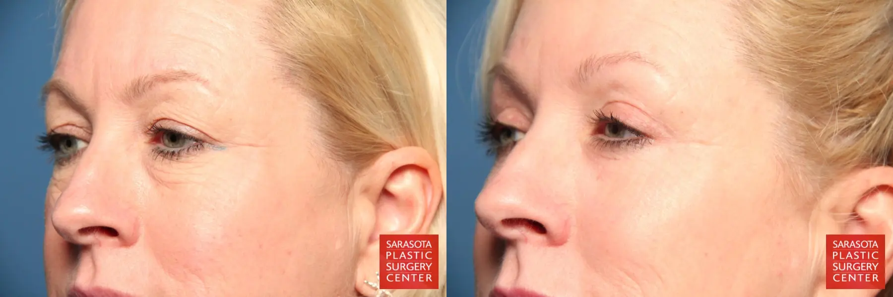Eyelid Lift: Patient 4 - Before and After 2