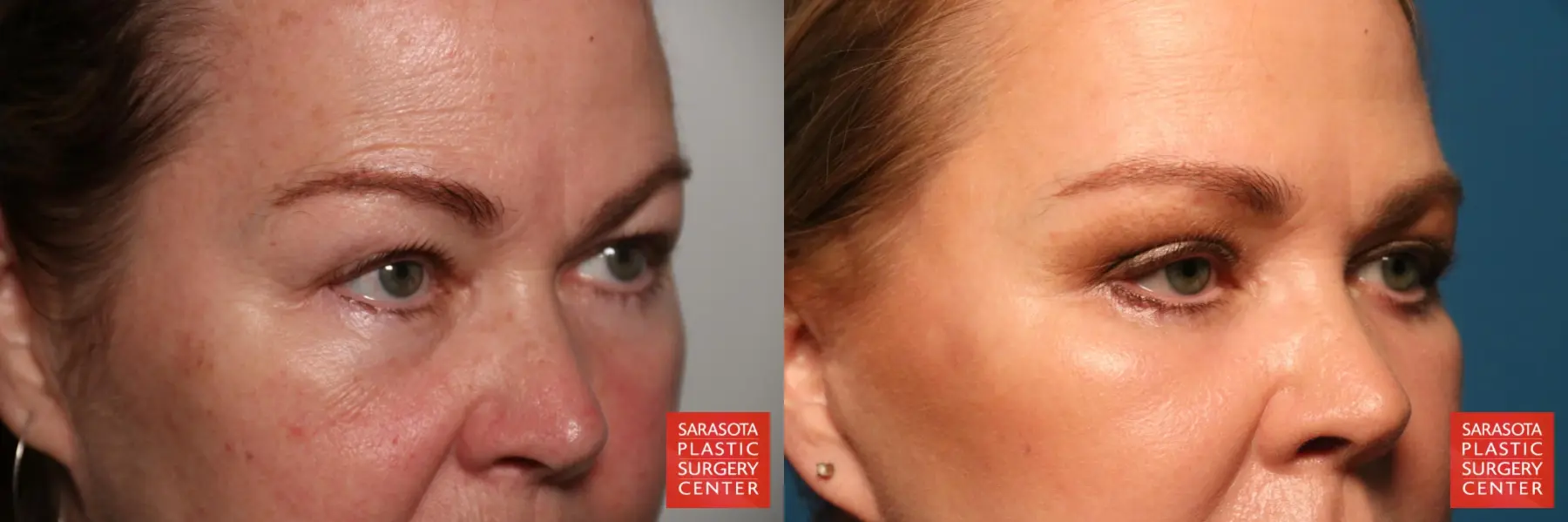 Eyelid Lift: Patient 44 - Before and After 4