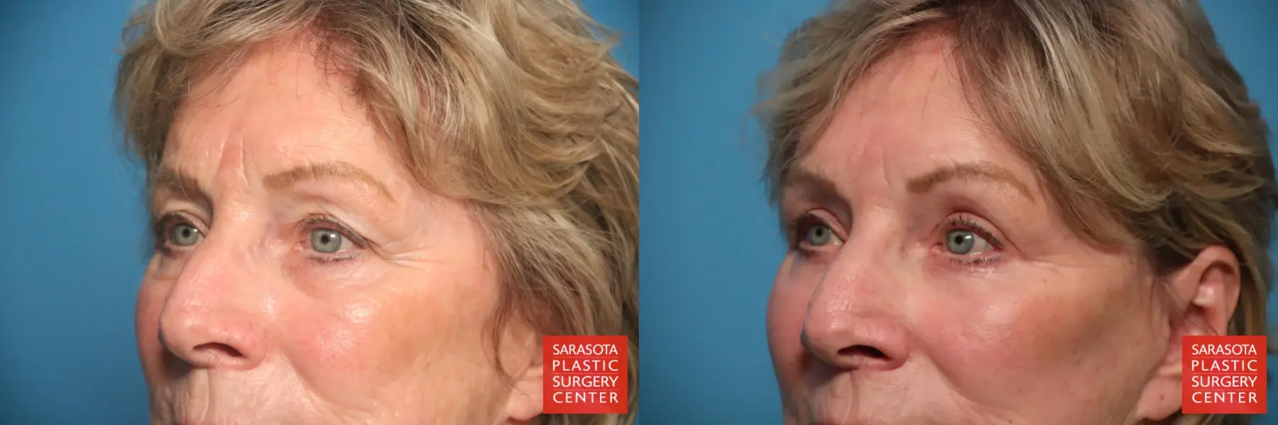 Eyelid Lift: Patient 63 - Before and After 2