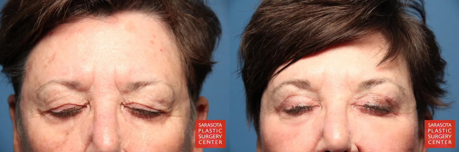 Eyelid Lift: Patient 17 - Before and After 2
