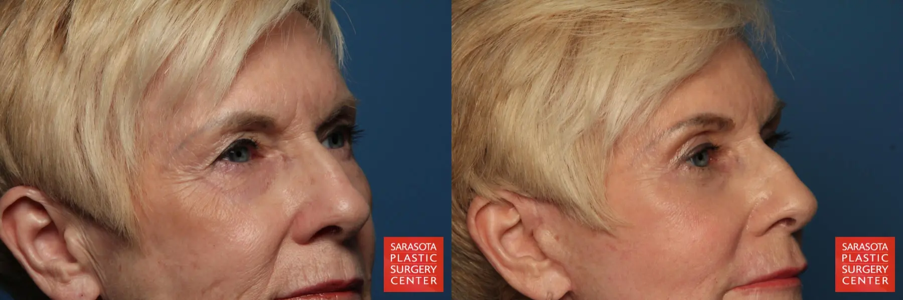 Eyelid Lift: Patient 30 - Before and After 4