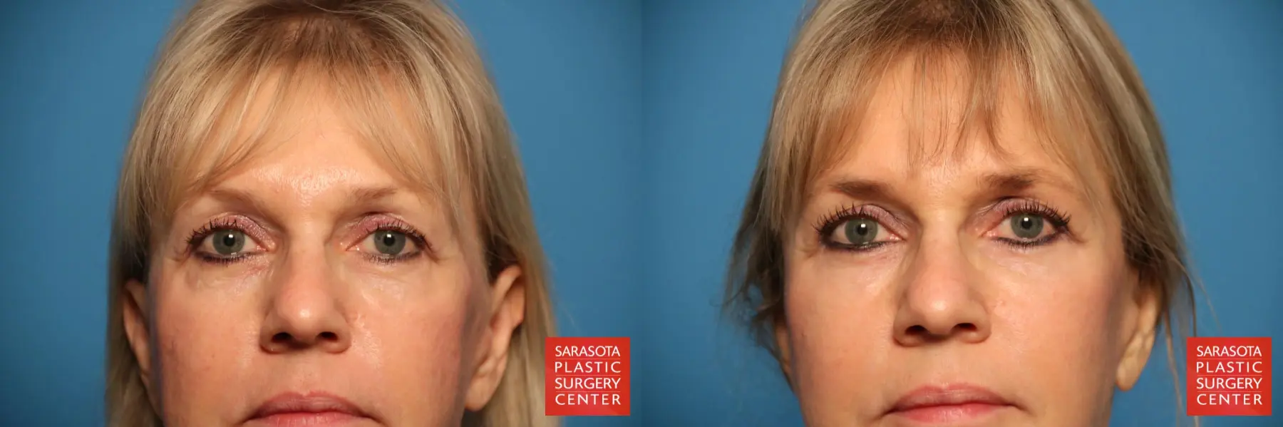Eyelid Lift: Patient 7 - Before and After  