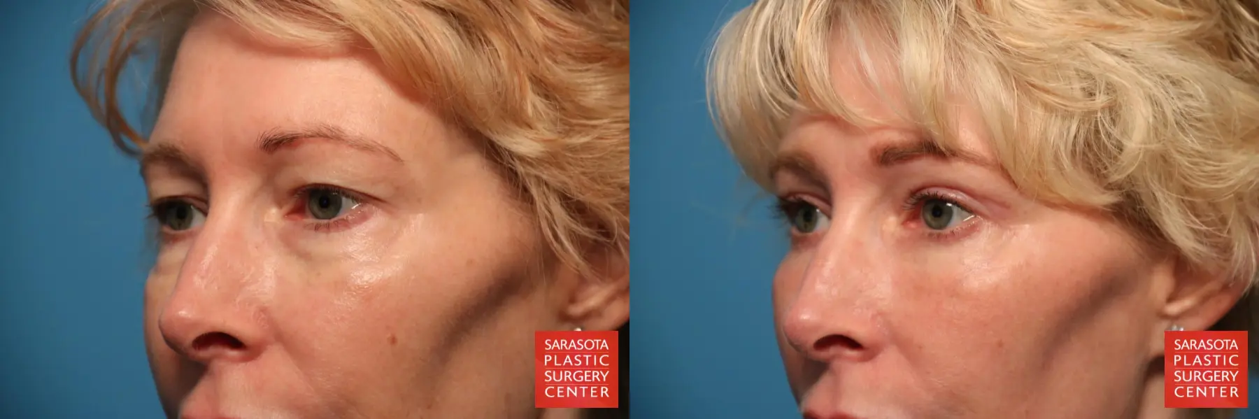 Eyelid Lift: Patient 12 - Before and After 3