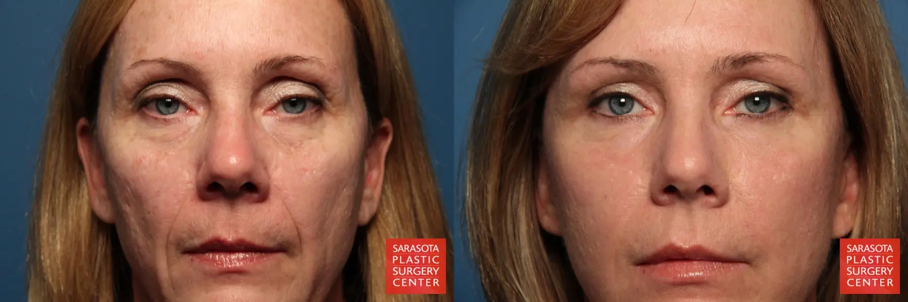 Eyelid Lift: Patient 2 - Before and After 1