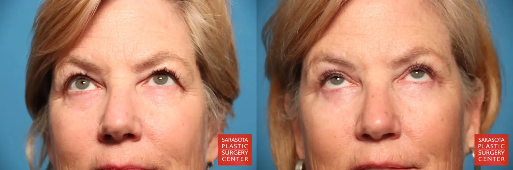 Eyelid Lift: Patient 51 - Before and After 2