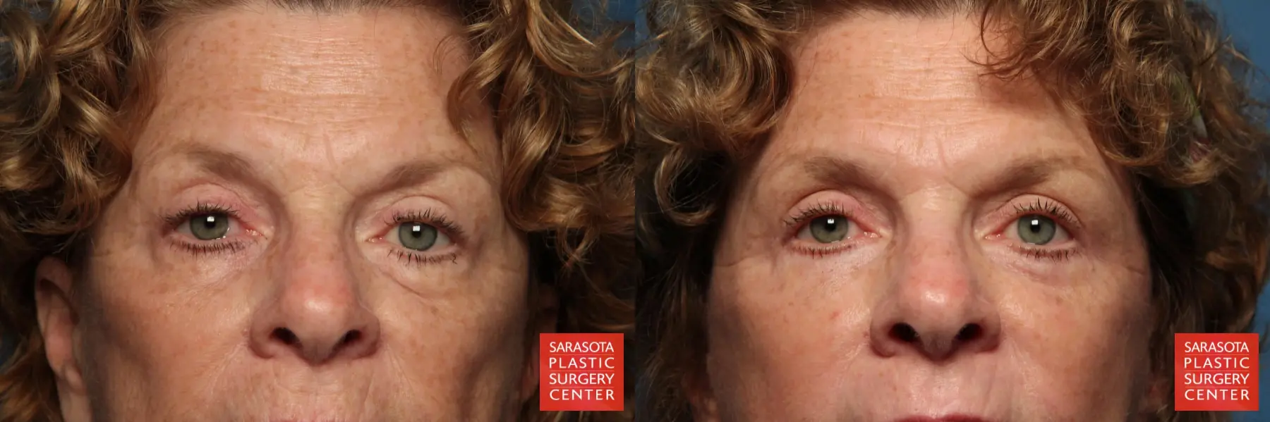 Eyelid Lift: Patient 25 - Before and After 1