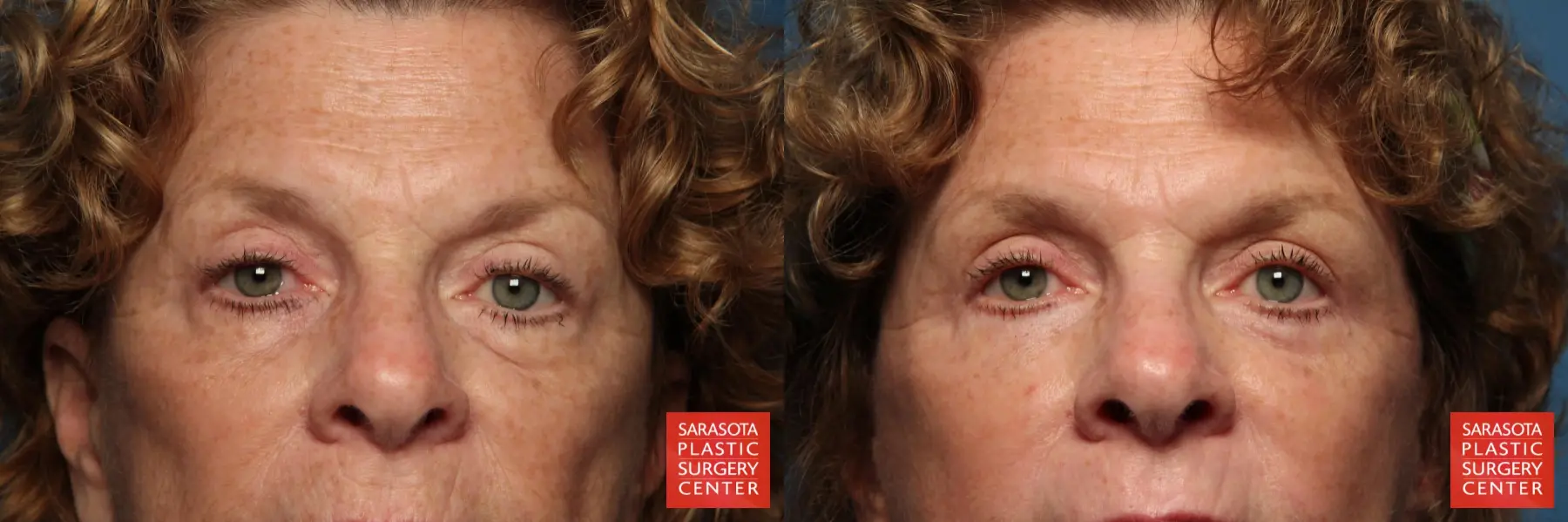 Eyelid Lift: Patient 27 - Before and After  