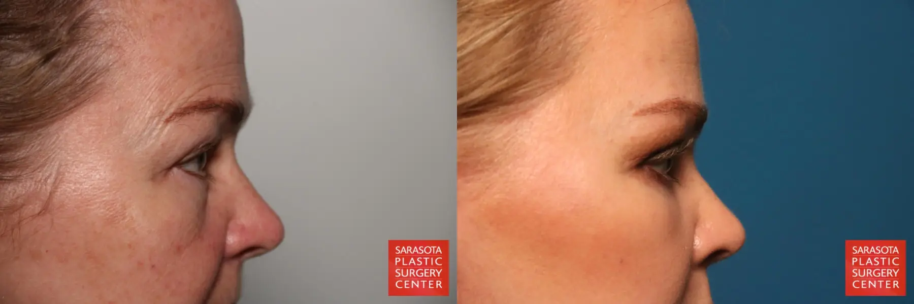 Eyelid Lift: Patient 44 - Before and After 5