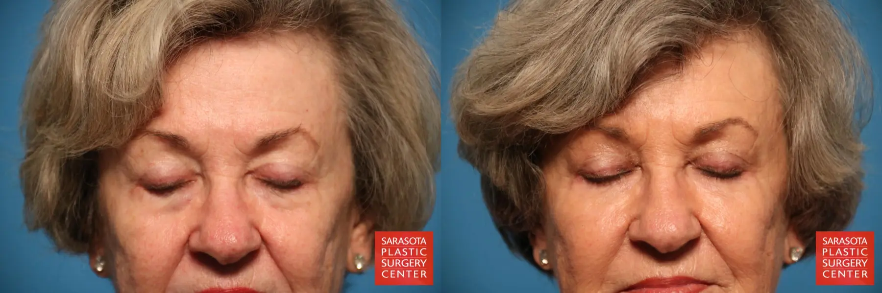 Eyelid Lift: Patient 14 - Before and After 2