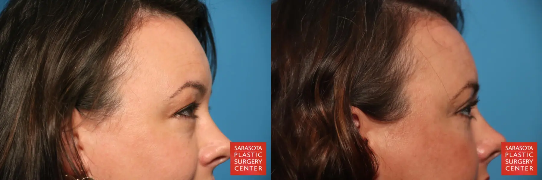 Eyelid Lift: Patient 60 - Before and After 5