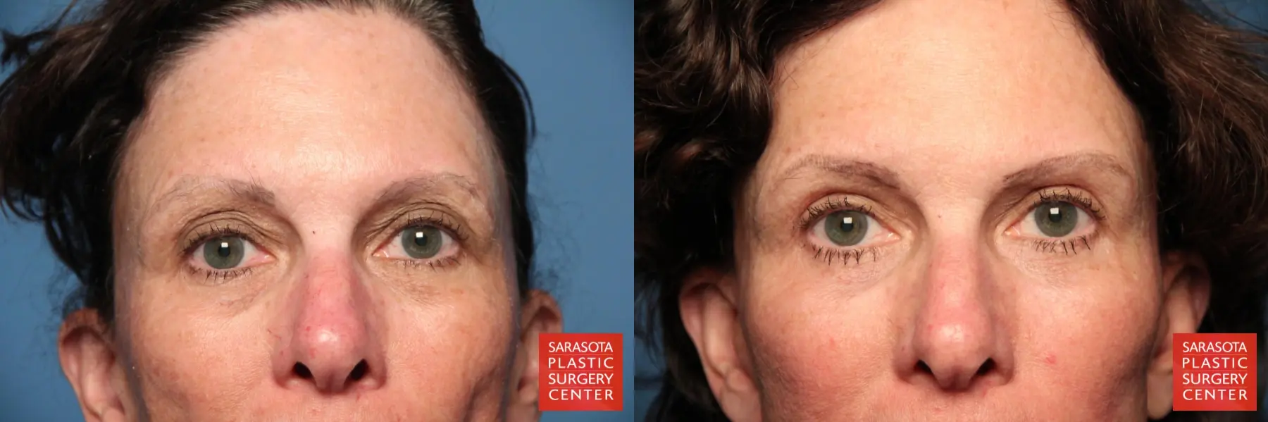 Eyelid Lift: Patient 8 - Before and After  