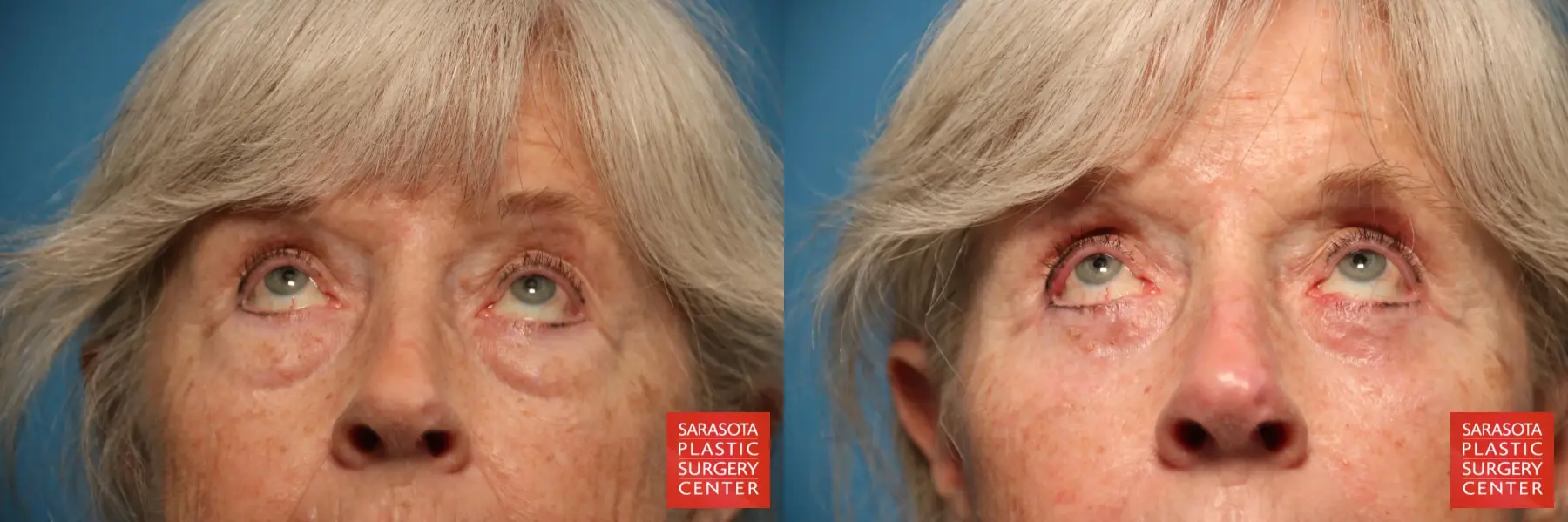 Eyelid Lift: Patient 15 - Before and After 2