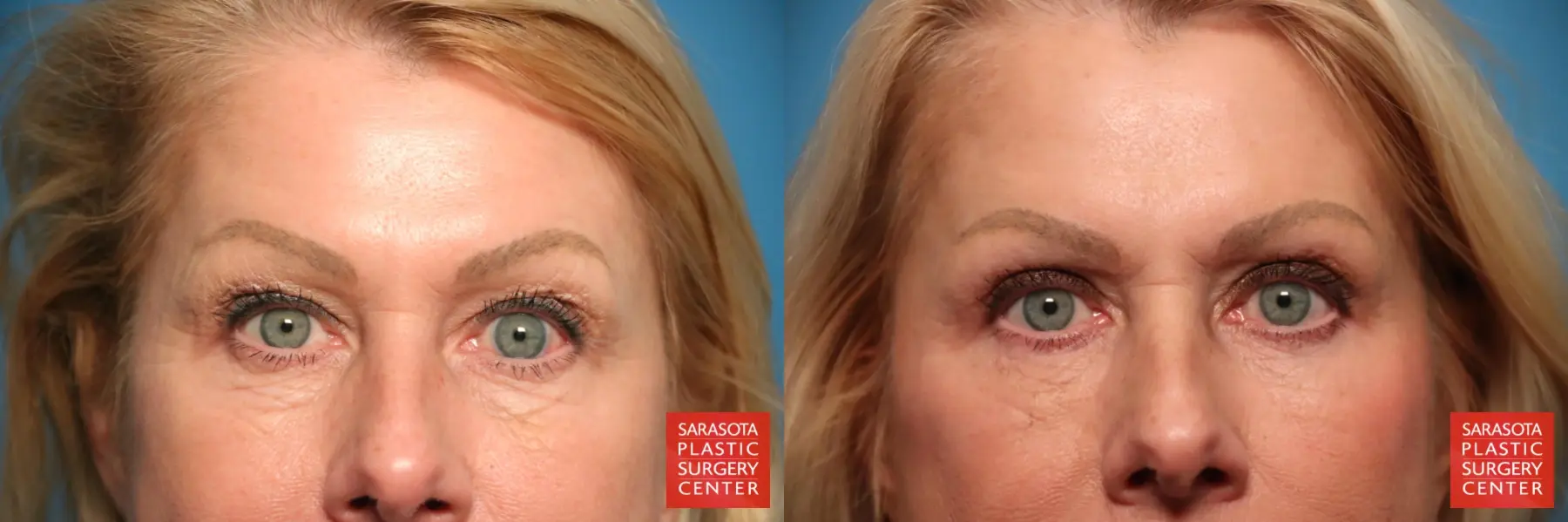 Eyelid Lift: Patient 59 - Before and After 1