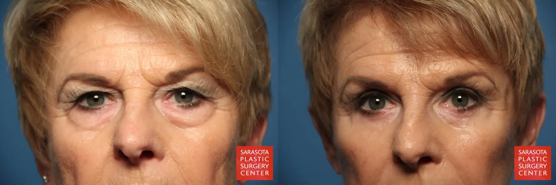 Eyelid Lift: Patient 12 - Before and After  